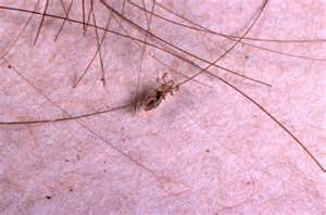 Lice on hair 